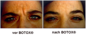 vorbotox nach botox 2